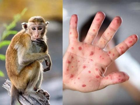 Phát hiện thêm ca bệnh đậu mùa khỉ, Bộ Y tế khuyến cáo

