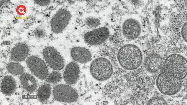 Nhật Bản thông báo ca tử vong đầu tiên do bệnh đậu mùa khỉ