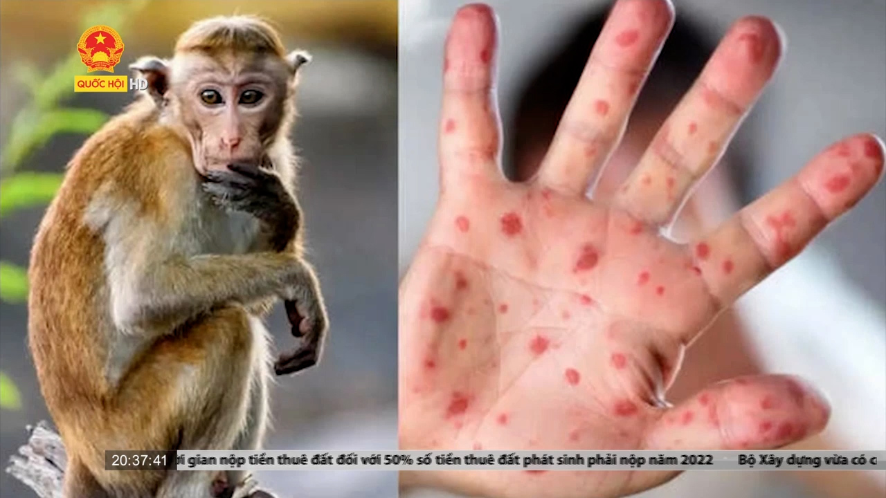 Thế giới đang làm gì để ứng phó với dịch đậu mùa khỉ
