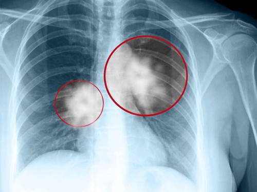 Cách lựa chọn thảo dược giúp ức chế sự nhân lên và di căn của khối u, u phổi