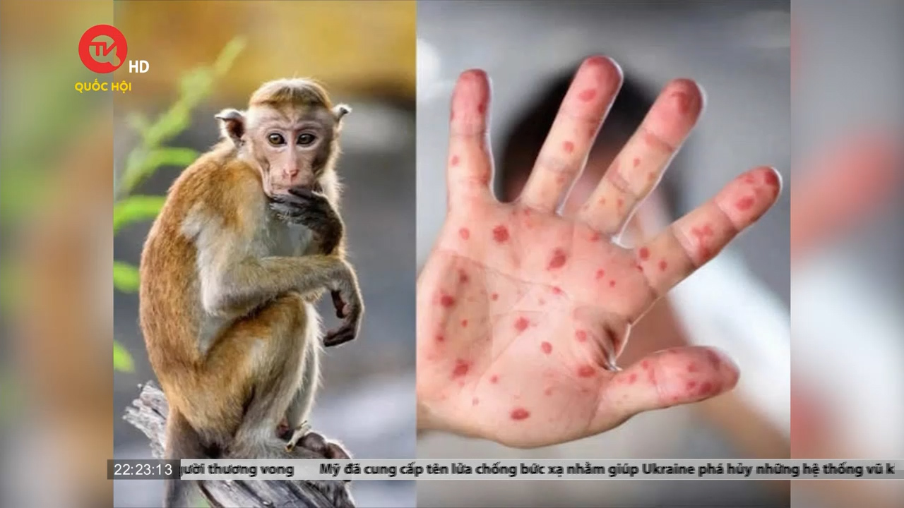 Việt Nam sẵn sàng kịch bản khi bệnh đậu mùa khỉ xâm nhập